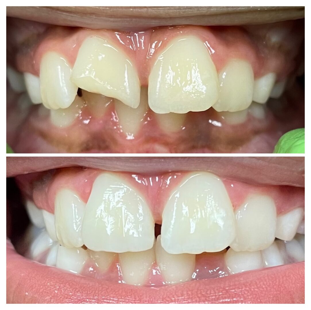A before and after picture of the teeth with missing tooth.